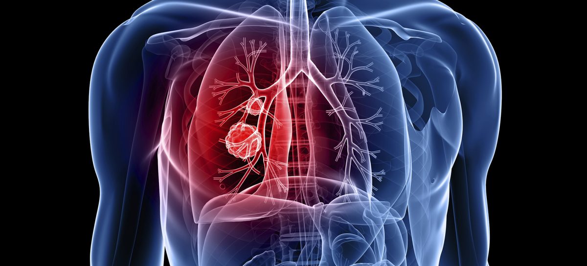 Flux sanguin Tratamentul cu radioterapie la pacienții cu cancer pulmonar, asociat cu o creștere a mortalității cardiace