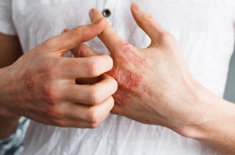 Deficienţa acestei vitamine, legată de severitatea psoriazisului