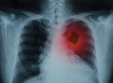 Românii pot afla online dacă plămânii lor prezintă simptomele unui cancer pulmonar