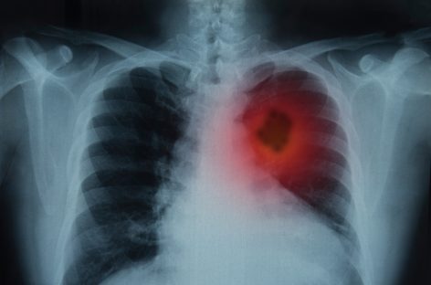 Românii pot afla online dacă plămânii lor prezintă simptomele unui cancer pulmonar