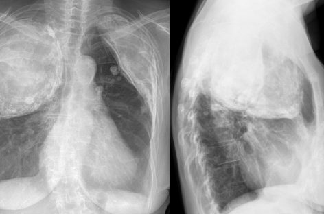 O nouă metodă de tratare a tuberculozei rezistente la medicamente prin îmbunătățirea apărărilor imunitare ale pacienților