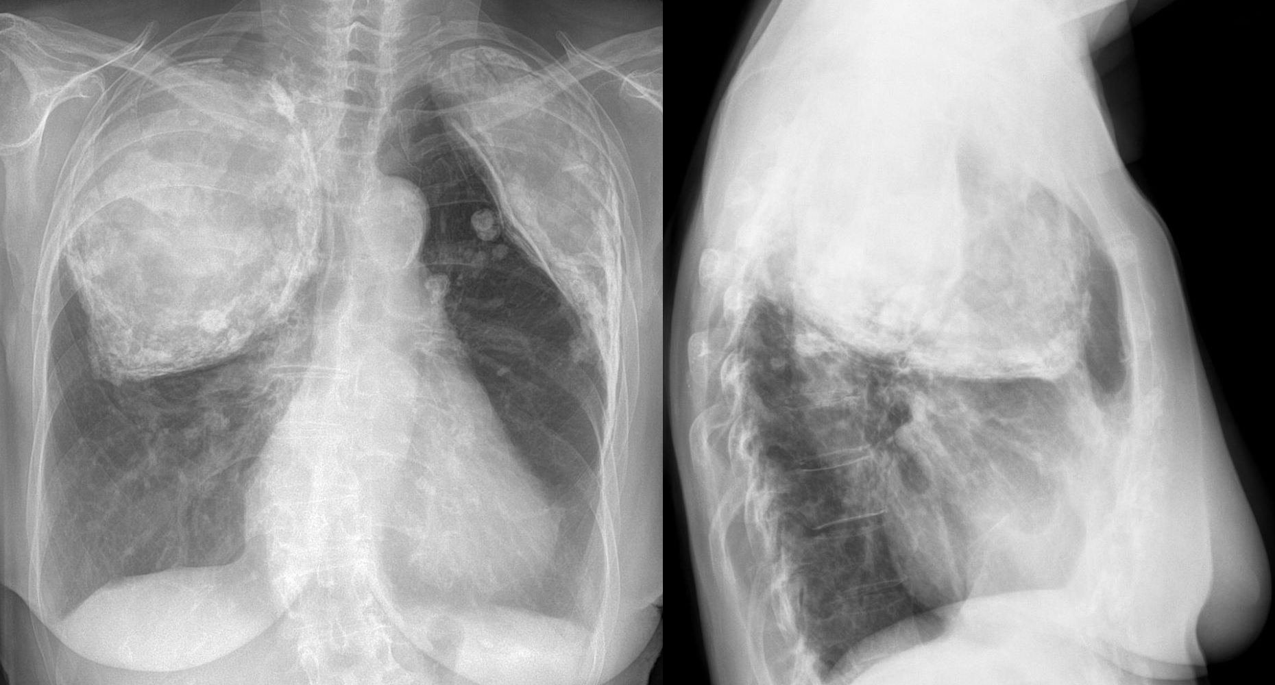 Ministerul Sănătăţii va derula în 2020 un proiect pilot pentru tratarea în ambulatoriu a cel puţin 200 de pacienţi cu tuberculoză din Bucureşti