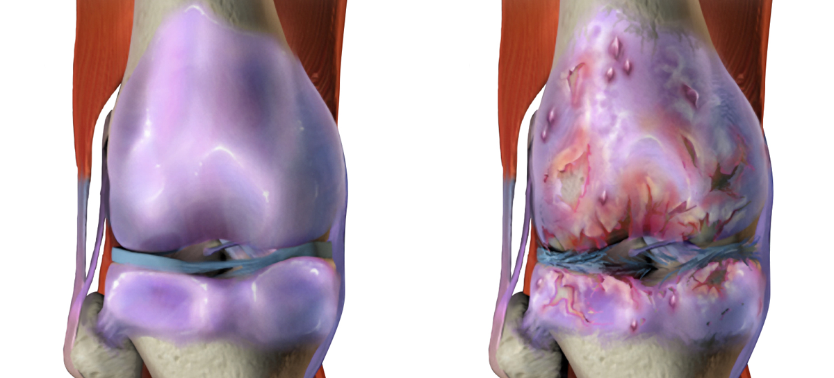 Osteoartrita Un derivat al omega-3 este eficient în tratamentul osteoartritei, susțin cercetătorii australieni