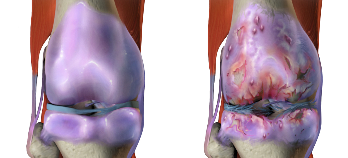 O meodă care ar putea bloca evoluția osteoartritei, descoperită de cercetători canadieni