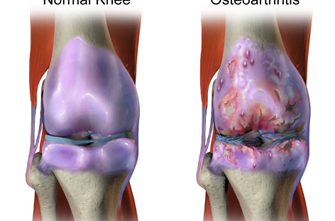 O cale de semnalizare a durerii în osteoartrită, identificată de cercetători