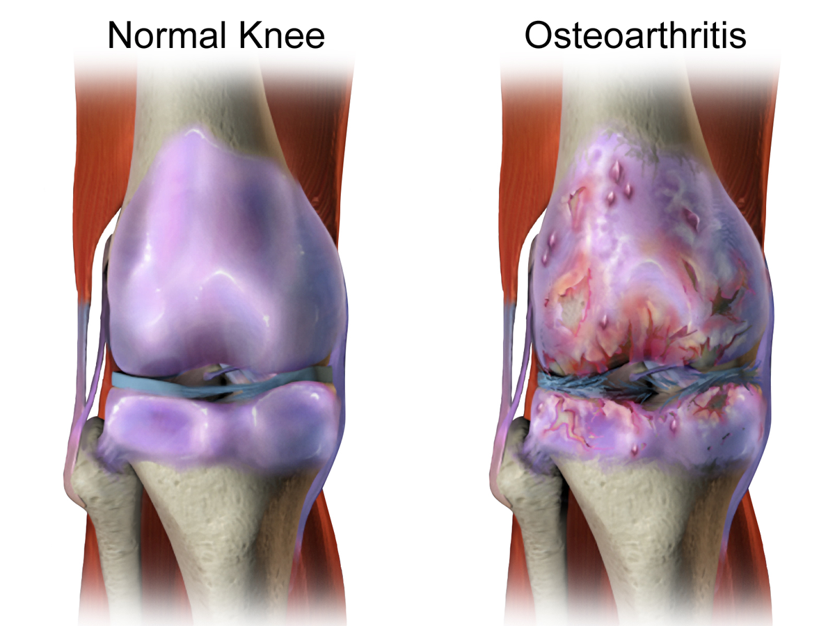 O cale de semnalizare a durerii în osteoartrită, identificată de cercetători