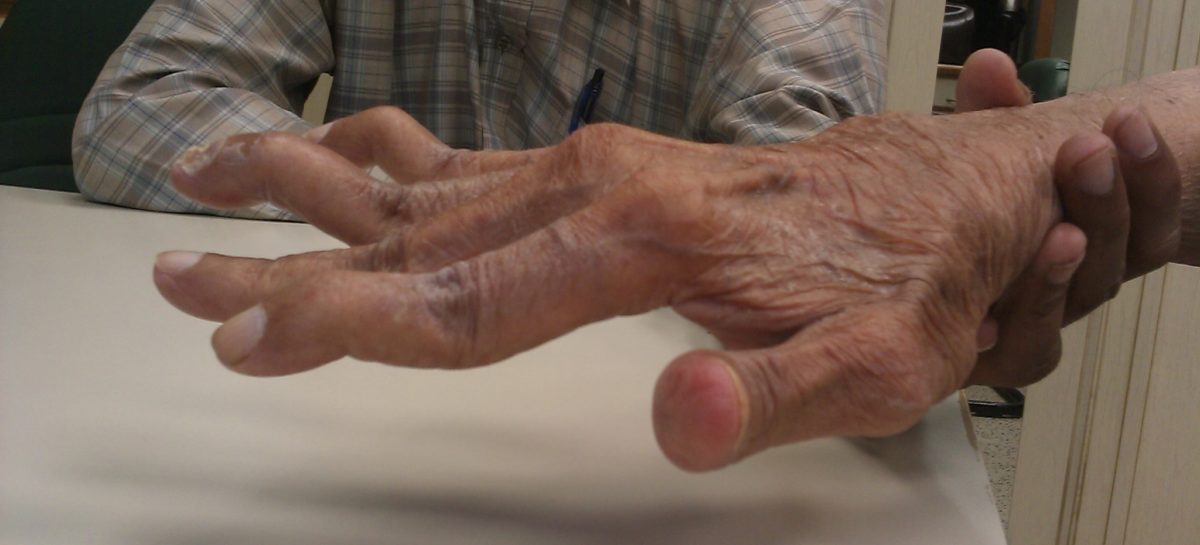 Poliartrita reumatoidă crește riscul de depresie, obezitate și boli cardiovasculare