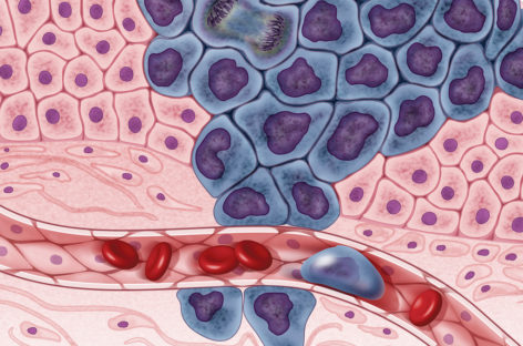 Cancerul şi infarctul miocardic ar putea fi diagnosticate mai uşor cu ajutorul unui test rapid de sânge