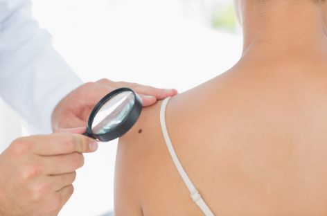 Asocierea a două medicamente ar putea fi mai eficientă împotriva melanomului