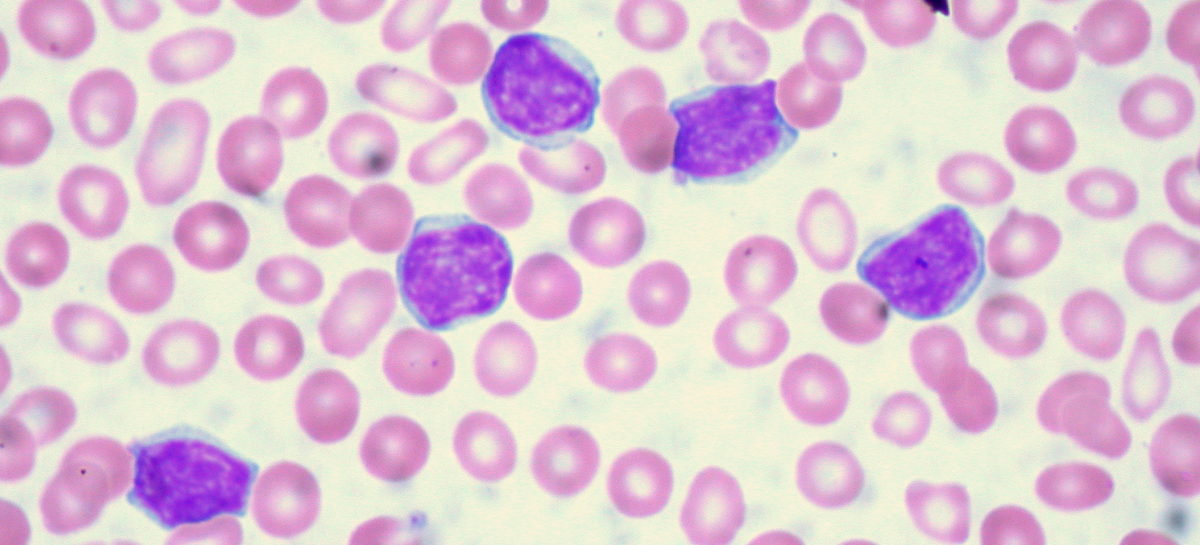 O vulnerabilitate a celulelor leucemice, posibilă țintă de tratament