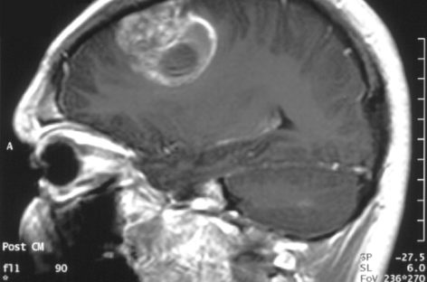 Noi biomarkeri ai glioblastomului identificaţi de cercetători ar putea sta la baza dezvoltării unor tratamente mai eficiente