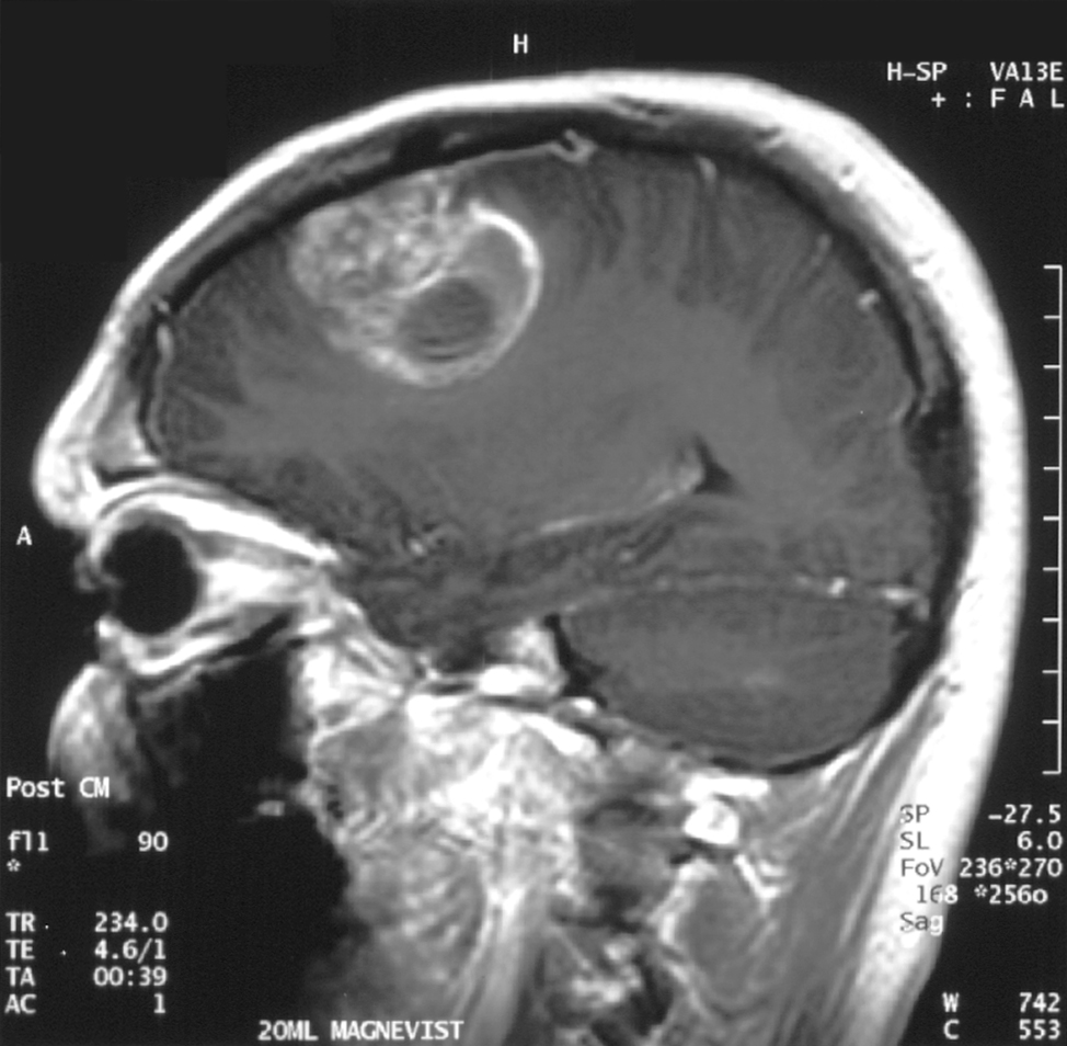 Noi biomarkeri ai glioblastomului identificaţi de cercetători ar putea sta la baza dezvoltării unor tratamente mai eficiente