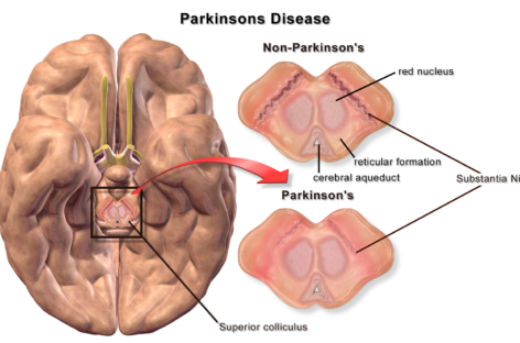 Parkinson o boală autoimună cauzată de infecţie intestinală susţin cercetătorii canadieni