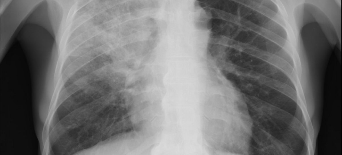 pneumonie Pneumonia bacteriană asociată cu probleme cardiace mai grave