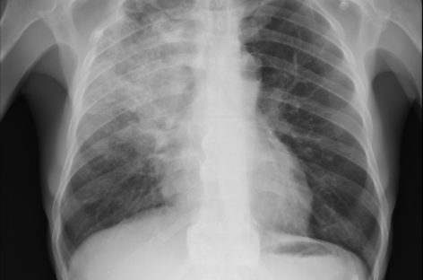 Pneumonia bacteriană asociată cu probleme cardiace mai grave