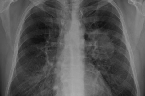 Nouă metodă de identificare și tratare a cancerelor pulmonare în stadiu incipient