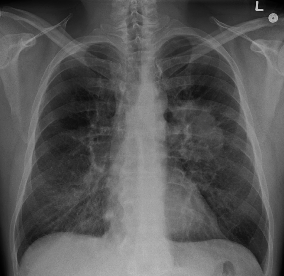 Nouă metodă de identificare şi tratare a cancerelor pulmonare în stadiu incipient