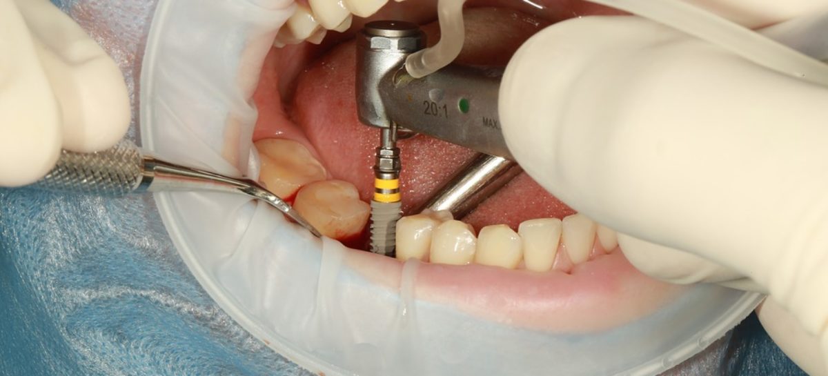 Riscurile implanturilor dentare