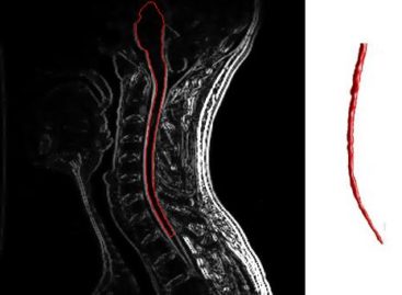 Un nou test de anticorpi pentru diagnosticarea sclerozei multiple, dezvoltat de cercetători