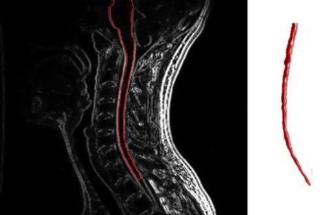 Un nou test de anticorpi pentru diagnosticarea sclerozei multiple, dezvoltat de cercetători