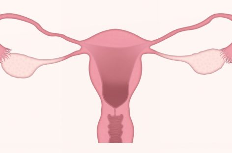 Adenomioza - o afecţiune dificil de diagnosticat