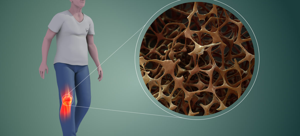 Un tratament pentru osteoporoză dezvoltat de Amgen a fost aprobat în SUA