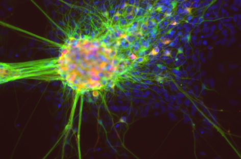 Celule stem modificate genetic, dezvoltate de oamenii de știință pentru a trata cancerul cerebral agresiv