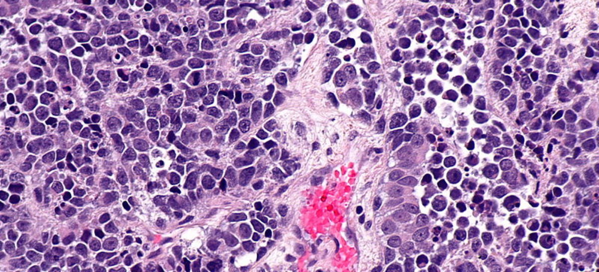 Cancer Cancer la vezică: Medicament care poate reduce cu o treime riscul de deces