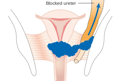 Recomandări pentru utilizarea radioterapiei și brahiterapiei în cancerul de col uterin