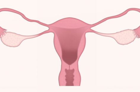 Tot ce trebuie să știți despre cancerul ovarian