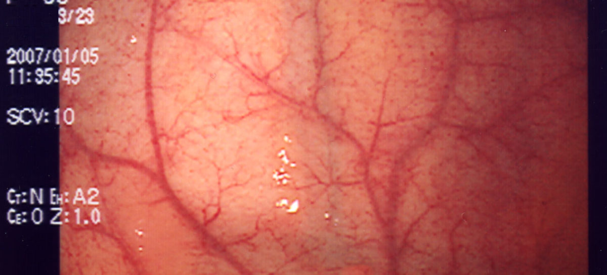 endoscopie Un dispozitiv cu ultrasunete folosit pentru imagistica optică va înlocui endoscopia susțin cercetătorii americani