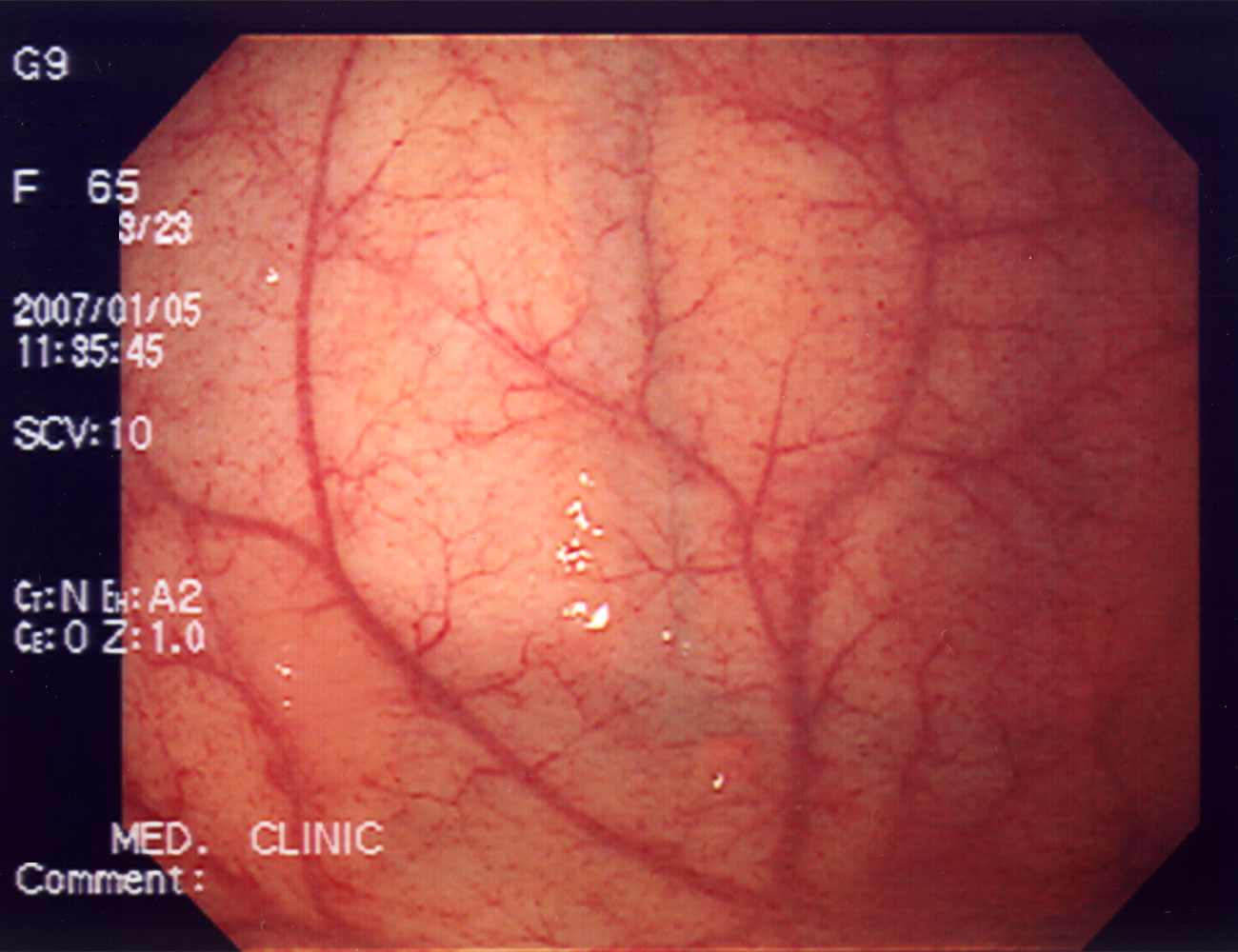 Un dispozitiv cu ultrasunete folosit pentru imagistica optică va înlocui endoscopia susţin cercetătorii americani