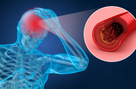 Dimensiunea arterelor cerebrale, factor de screening în identificarea persoanele expuse riscului de anevrism