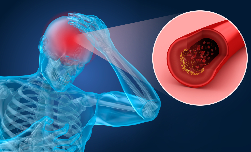 Ziua Mondială a Accidentului Vascular Cerebral: 29 octombrie