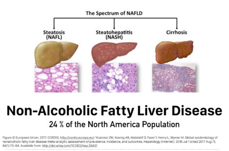 Studiu: Bacteriile intestinale producătoare de alcool ar putea provoca leziuni ale ficatului chiar şi la persoanele care nu beau