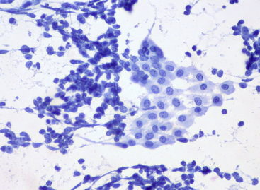 Noi cercetări ar putea îmbunătăți imunoterapia pentru cancerul pulmonar fără celule mici