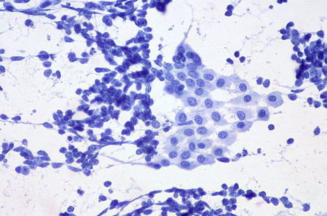 Un nou biomarker asociat cu supravieţuirea şi răspândirea tumoriilor poate duce la dezvoltatrea unui tratament împotriva celulelor stem canceroase