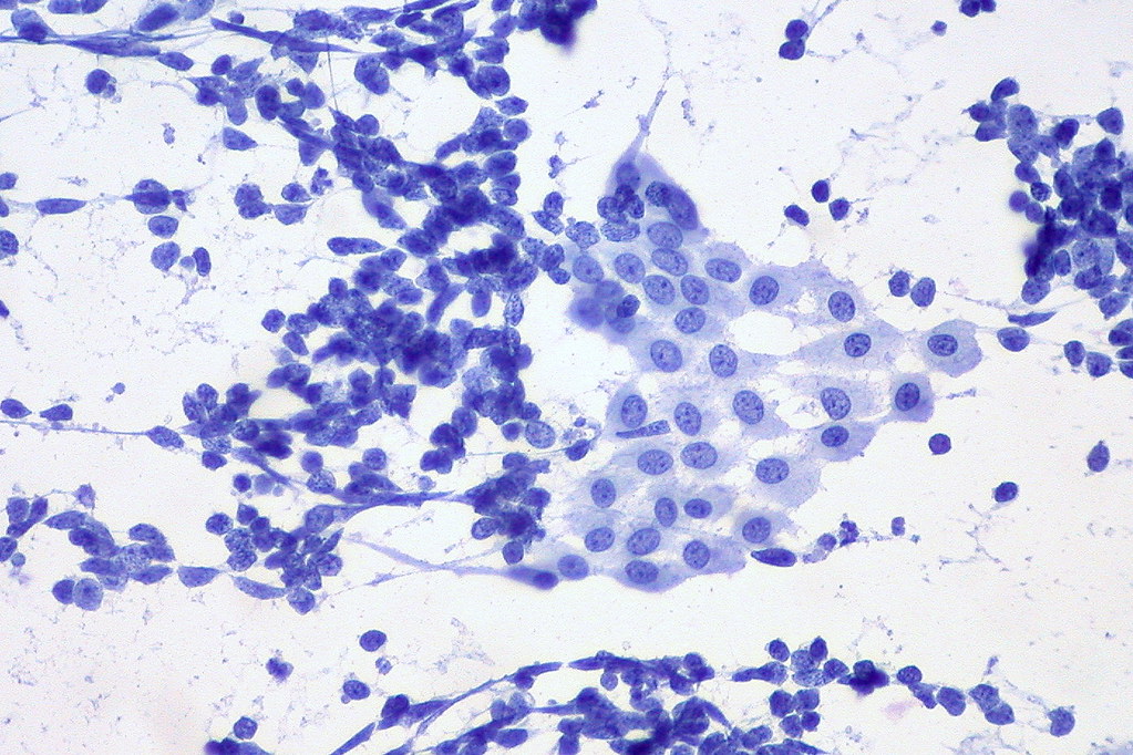 Un nou biomarker asociat cu supravieţuirea şi răspândirea tumoriilor poate duce la dezvoltatrea unui tratament împotriva celulelor stem canceroase