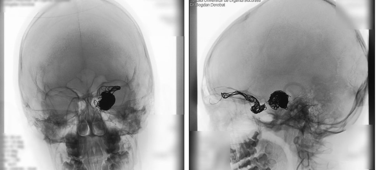 O echipă de medici de la Spitalul Universitar a realizat o embolizare de fistulă carotido-cavernoasă la un pacient tânăr ce risca să-și piardă vederea la un ochi