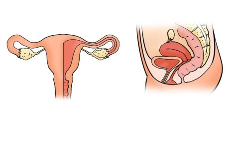 Fibromul uterin: aprope jumătate din cazuri sunt asimptomatice