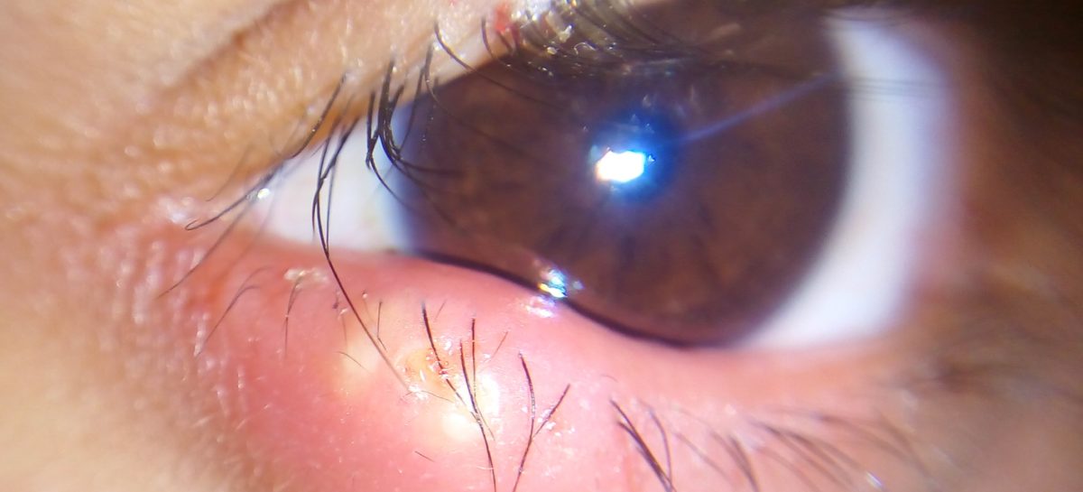 nistagmus congenital Cauza nistagmusului congenital este una retiniană afirmă cercetătorii olandezi