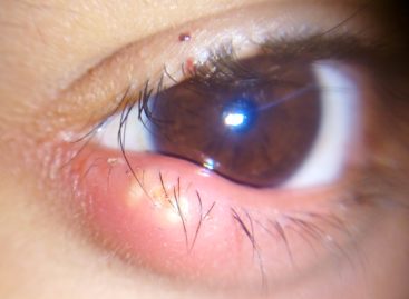 Cauza nistagmusului congenital este una retiniană afirmă cercetătorii olandezi