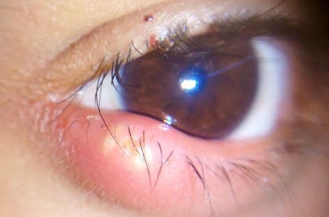 Cauza nistagmusului congenital este una retiniană afirmă cercetătorii olandezi