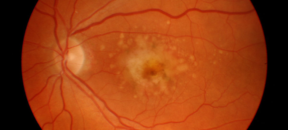 retinopatie diabetica O nouă modalitate pentru dezvoltarea unui tratament pentru retinopatie diabetică, identificată de cercetătorii americani