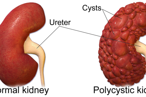 Un tratament dezvoltat în SUA pentru boala polichistică renală, considerată incurabilă, a obţinut rezultate promiţătoare în teste