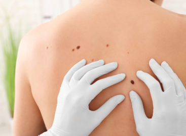 EMA va reevalua riscurile privind utilizarea gelului Picato pentru tratamentul keratozei actinice, după ce s-au raportat mai multe cazuri de cancer de piele