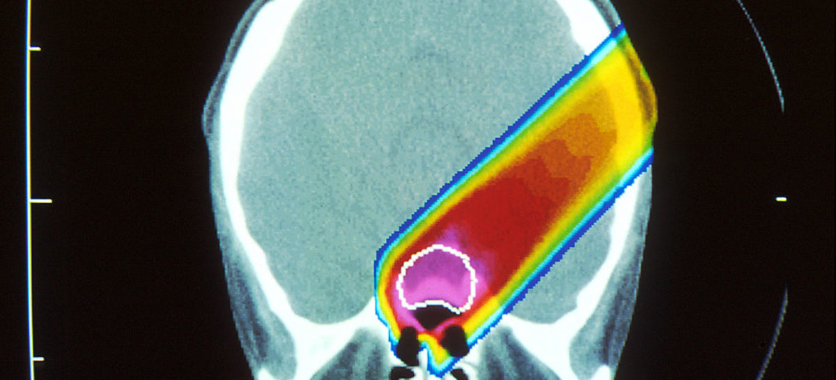 terapia cu protoni Terapia cu protoni asigură speranțe mai mari de supraviețuire în cazul copiilor cu cancer cerebral