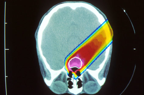 Terapia cu protoni asigură speranţe mai mari de supravieţuire în cazul copiilor cu cancer cerebral