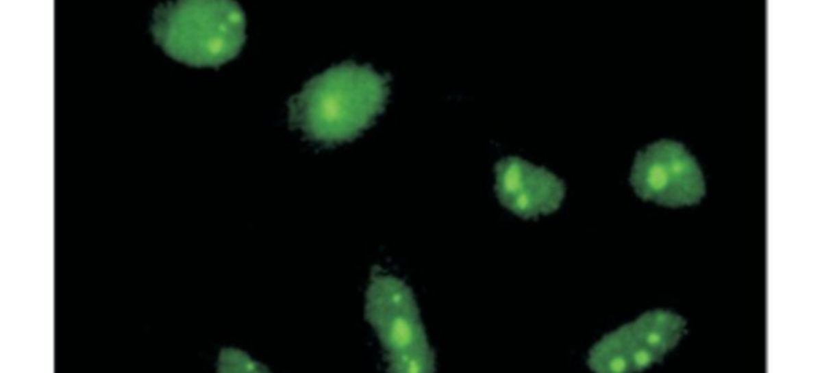cilindromatoza Caracteristicile genetice ale cilindromatozei familiale, identificate de cercetătorii britanici