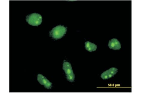 Caracteristicile genetice ale cilindromatozei familiale, identificate de cercetătorii britanici